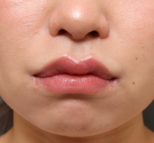 20代女性の人中短縮(リップリフト) After 症例写真