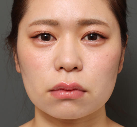 20代女性の人中短縮(リップリフト) Before 症例写真