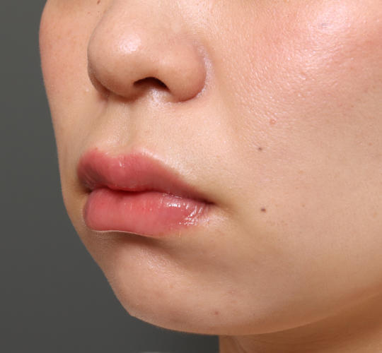 20代女性の人中短縮(リップリフト) Before 症例写真