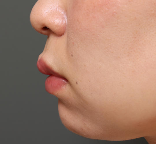 20代女性の人中短縮(リップリフト) Before 症例写真