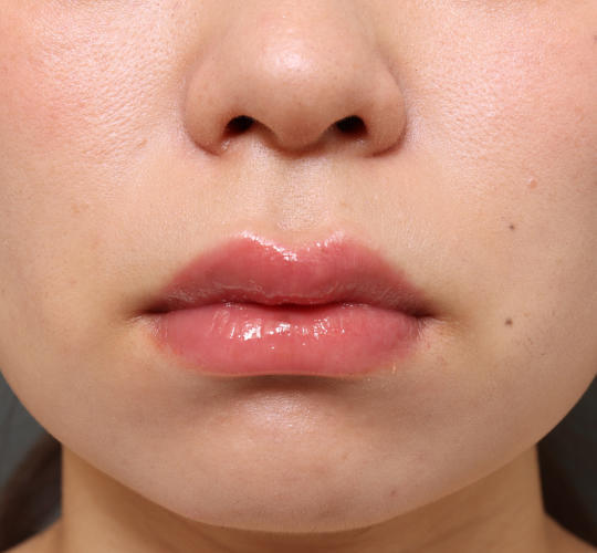 20代女性の人中短縮(リップリフト) Before 症例写真