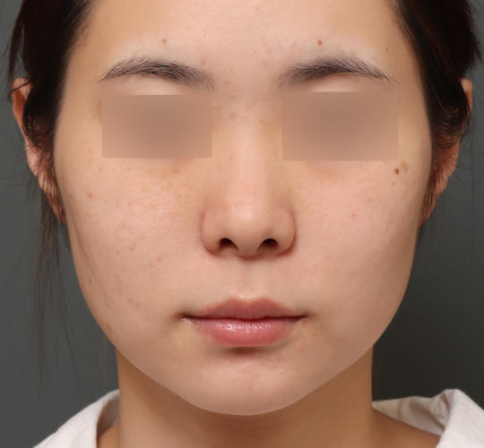 20代女性の肌管理毛穴スリークスキン(ダーマペン4) After 症例写真