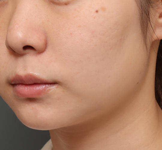 20代女性の毛穴・黒ずみ After 症例写真