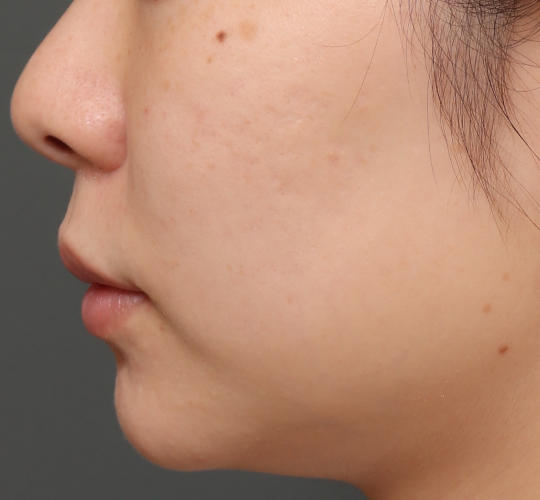 20代女性の肌管理毛穴スリークスキン(ダーマペン4) After 症例写真