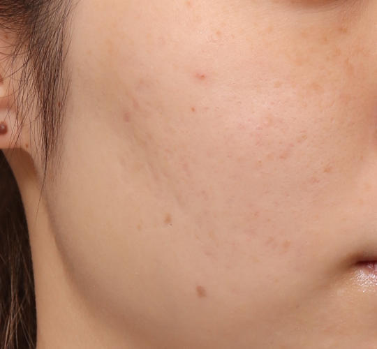 20代女性の肌管理毛穴スリークスキン(ダーマペン4) After 症例写真