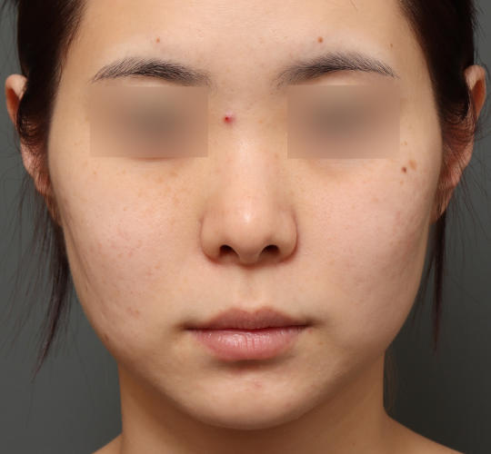 20代女性の肌管理毛穴スリークスキン(ダーマペン4) Before 症例写真