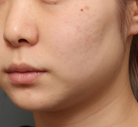 20代女性の毛穴・黒ずみ Before 症例写真