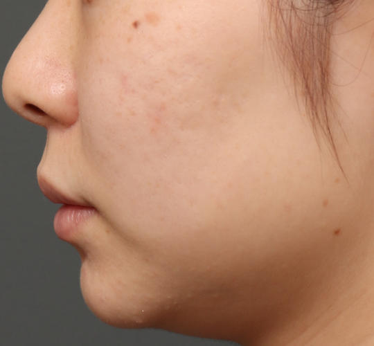 20代女性の肌管理毛穴スリークスキン(ダーマペン4) Before 症例写真