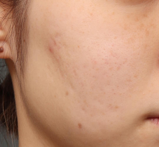 20代女性の肌管理毛穴スリークスキン(ダーマペン4) Before 症例写真