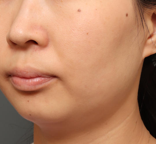 30代女性の毛穴・黒ずみ After 症例写真