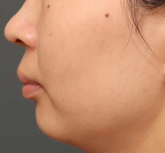 30代女性の肌管理毛穴スリークスキン(ダーマペン4) After 症例写真