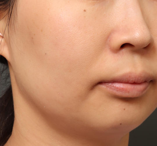 30代女性の肌管理毛穴スリークスキン(ダーマペン4) After 症例写真