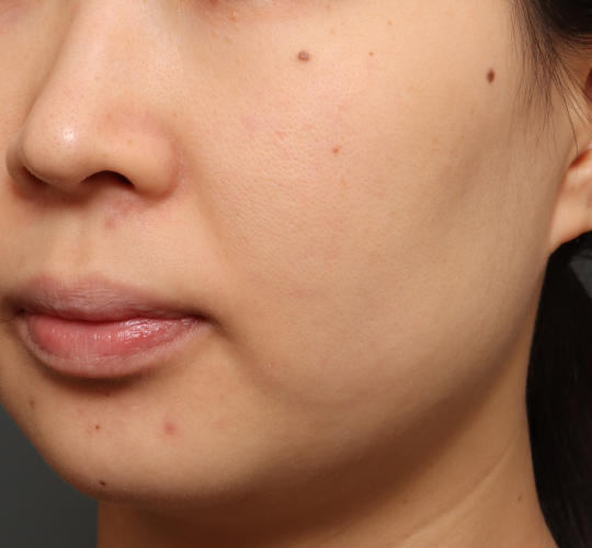 30代女性の毛穴・黒ずみ Before 症例写真