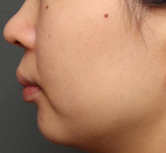 30代女性の肌管理毛穴スリークスキン(ダーマペン4) Before 症例写真