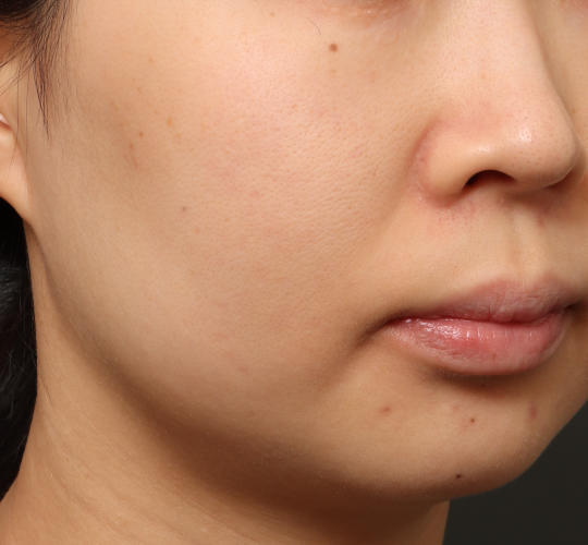 30代女性の肌管理毛穴スリークスキン(ダーマペン4) Before 症例写真