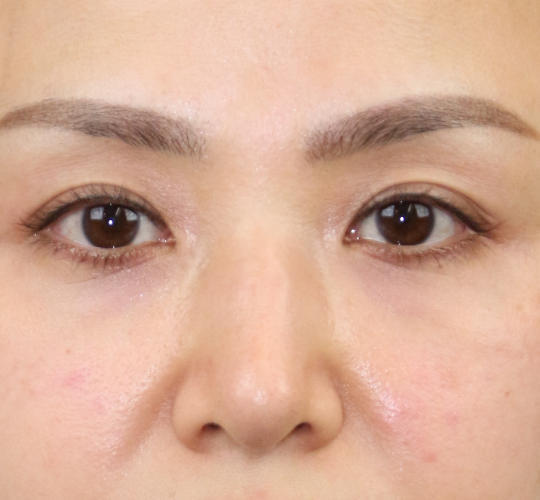 30代女性のヒアルロン酸注射（目の下） After 症例写真