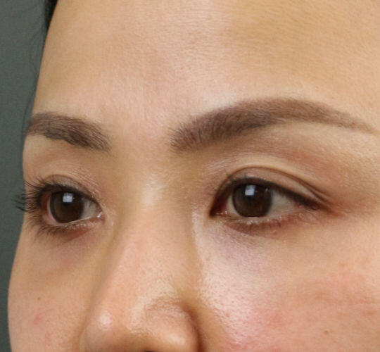 30代女性のヒアルロン酸注射(目の下) After 症例写真