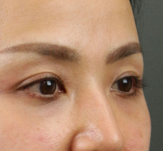 30代女性のヒアルロン酸注射（目の下） After 症例写真