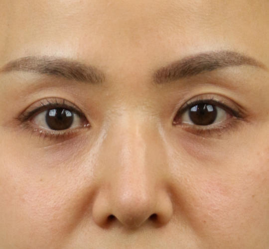 30代女性のヒアルロン酸注射（目の下） Before 症例写真