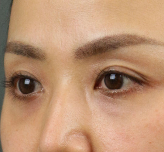 30代女性のヒアルロン酸注射(目の下) Before 症例写真