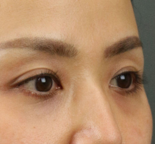 30代女性のヒアルロン酸注射（目の下） Before 症例写真