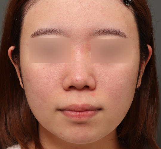 20代女性の肌管理毛穴スリークスキン(ダーマペン4) After 症例写真