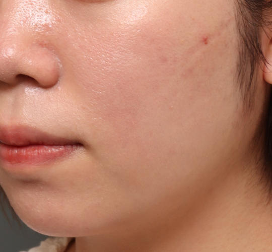 20代女性の肌管理毛穴スリークスキン(ダーマペン4) After 症例写真