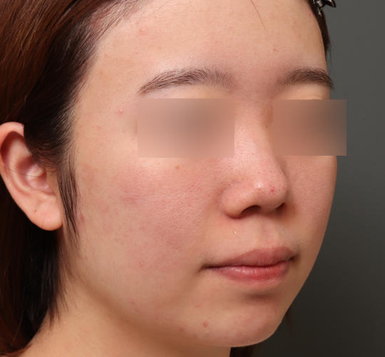 ニキビ跡の症例写真 公式 オザキクリニック 美容整形 美容外科 美容皮膚科 東京新宿 目黒祐天寺 羽村 ニキビ跡の症例写真 公式 オザキクリニック 美容整形 美容外科 美容皮膚科 東京新宿 目黒祐天寺 羽村