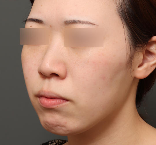 20代女性のピコシュア After 症例写真