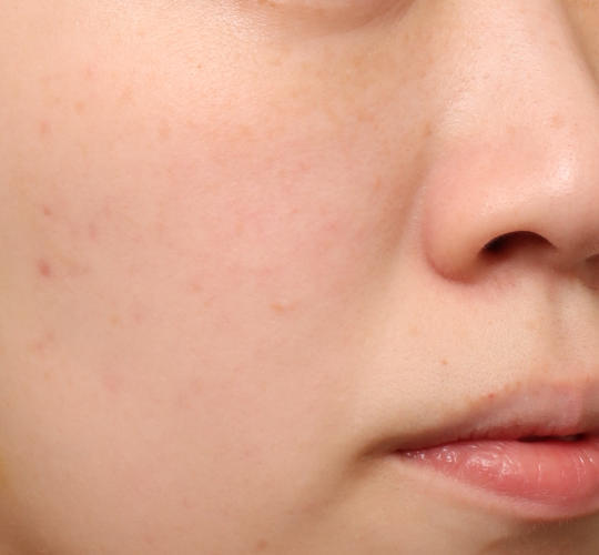 20代女性のピコシュア After 症例写真