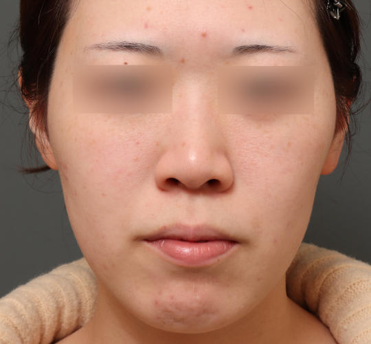 20代女性のシミ・そばかす Before 症例写真