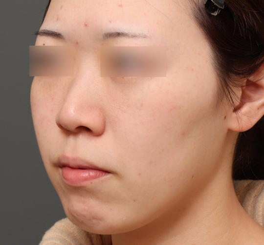 20代女性のピコシュア Before 症例写真