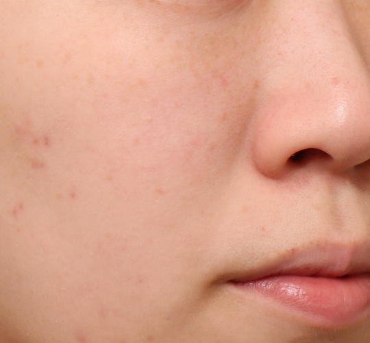 20代女性のピコシュア Before 症例写真