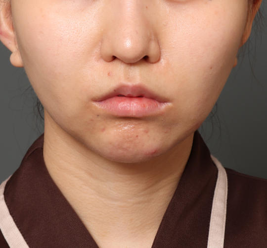 20代女性の人中短縮（リップリフト） After 症例写真