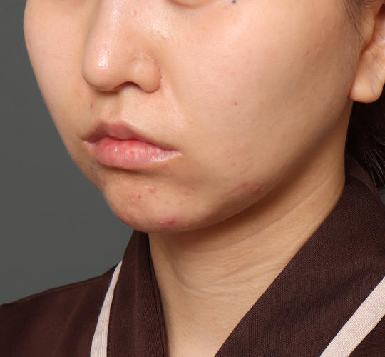 20代女性の人中短縮（リップリフト） After 症例写真