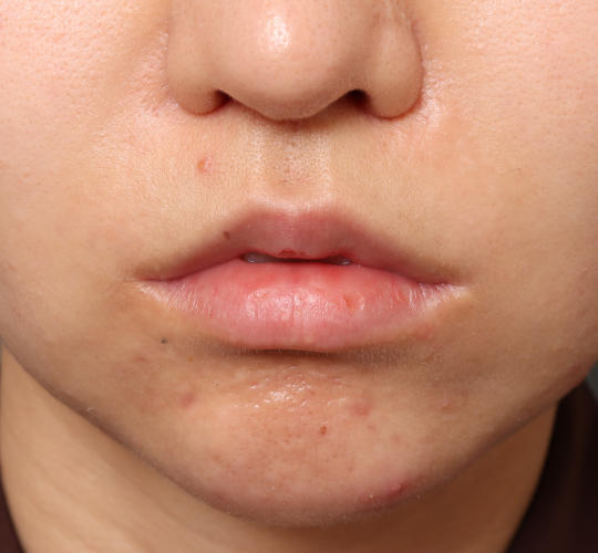 20代女性の人中短縮（リップリフト） After 症例写真