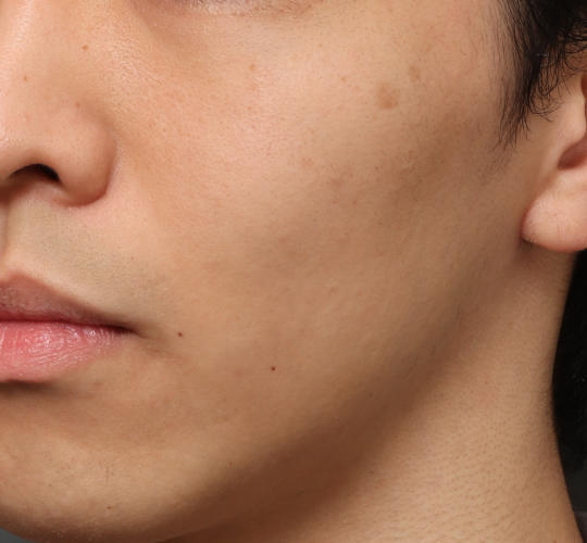 20代男性のVOVリフトプレミアム After 症例写真