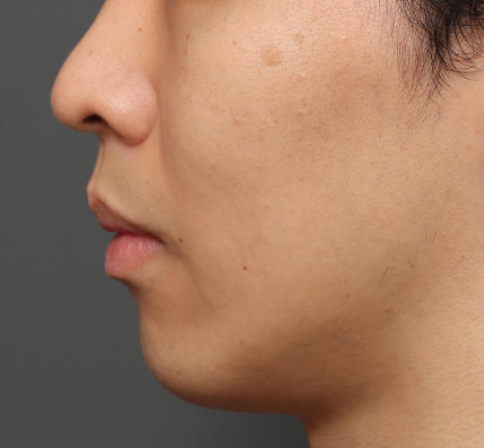 20代男性のメーラーファット除去 After 症例写真