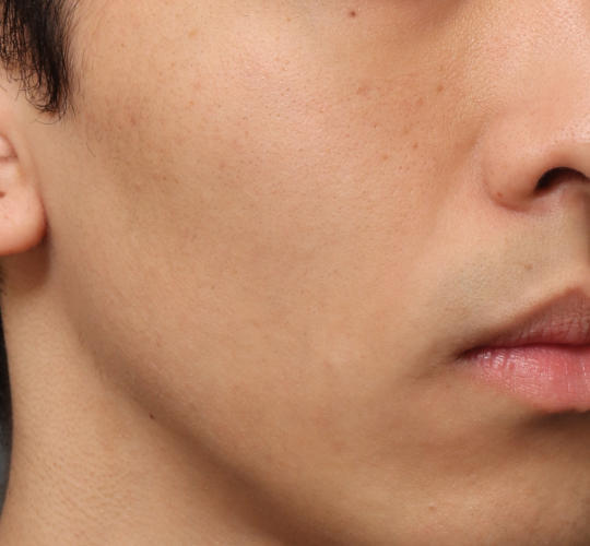 20代男性のメーラーファット除去 After 症例写真