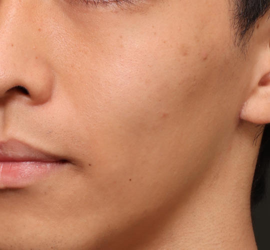 20代男性のVOVリフトプレミアム Before 症例写真