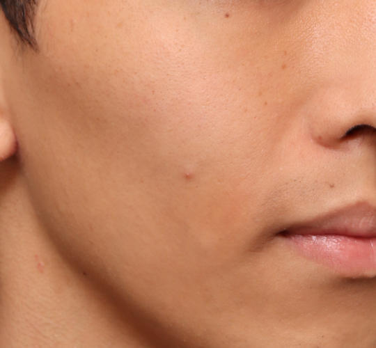 20代男性のメーラーファット除去 Before 症例写真