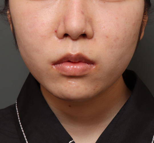 20代女性の口角挙上(スマイルリップ) After 症例写真