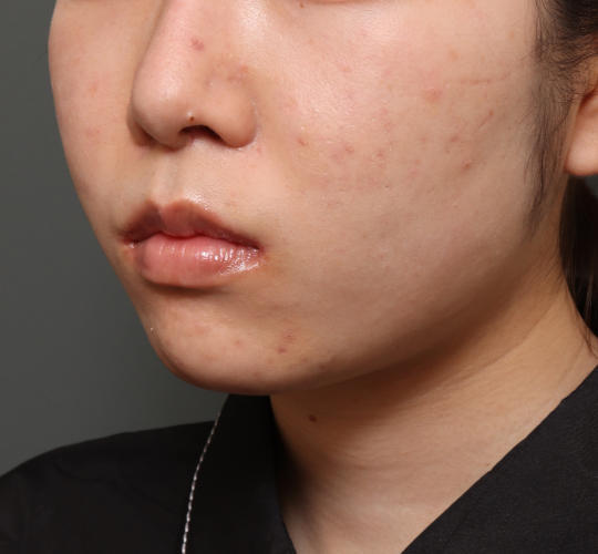 20代女性の口角挙上(スマイルリップ) After 症例写真