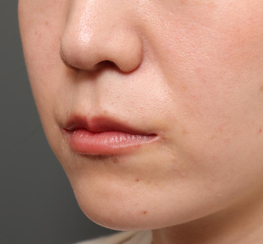 20代女性の人中短縮(リップリフト) After 症例写真