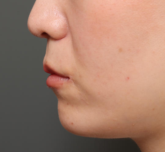 20代女性の人中短縮(リップリフト) After 症例写真