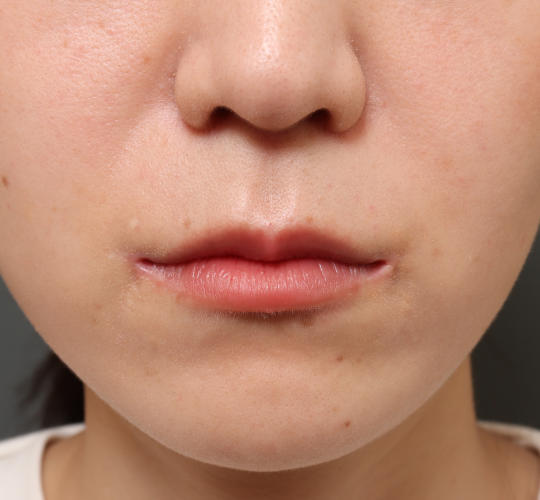 20代女性の人中短縮(リップリフト) After 症例写真