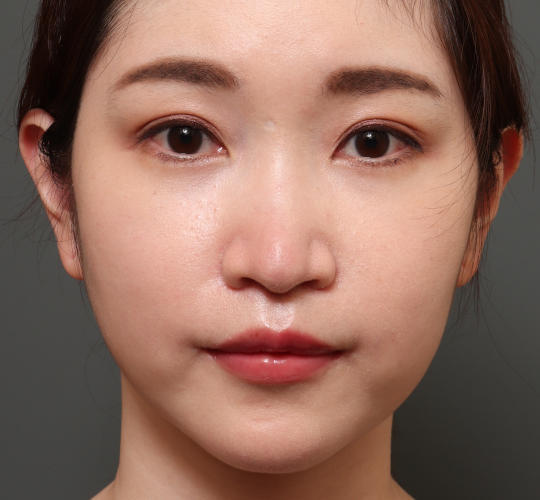 20代女性の人中短縮（リップリフト） After 症例写真