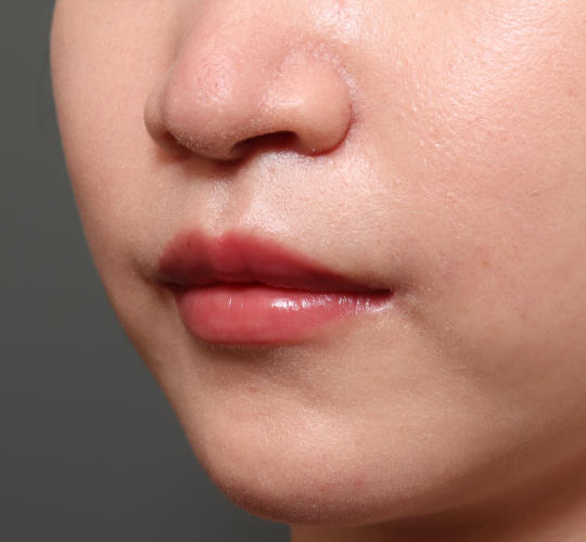 20代女性のM字リップ形成 After 症例写真