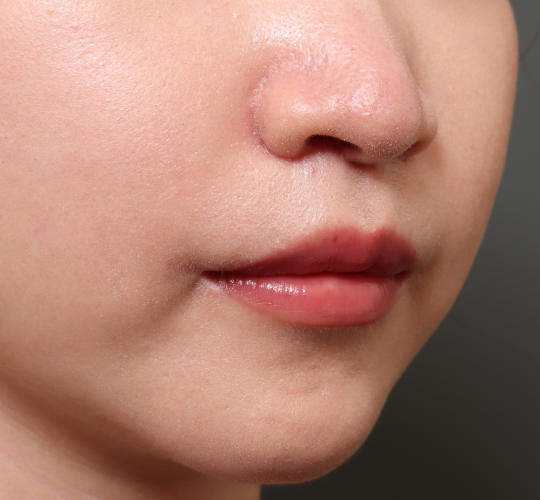 20代女性のM字リップ形成 After 症例写真