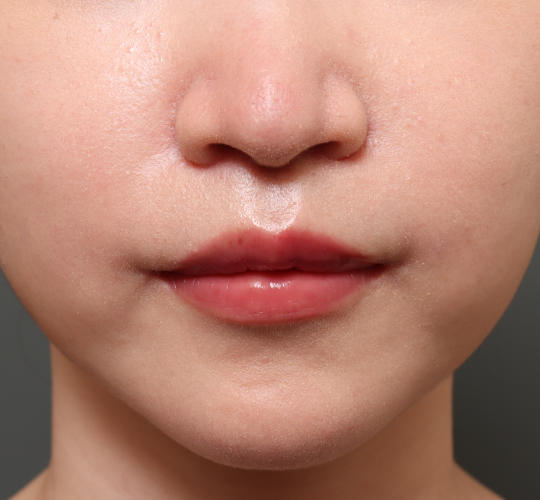 20代女性のM字リップ形成 After 症例写真